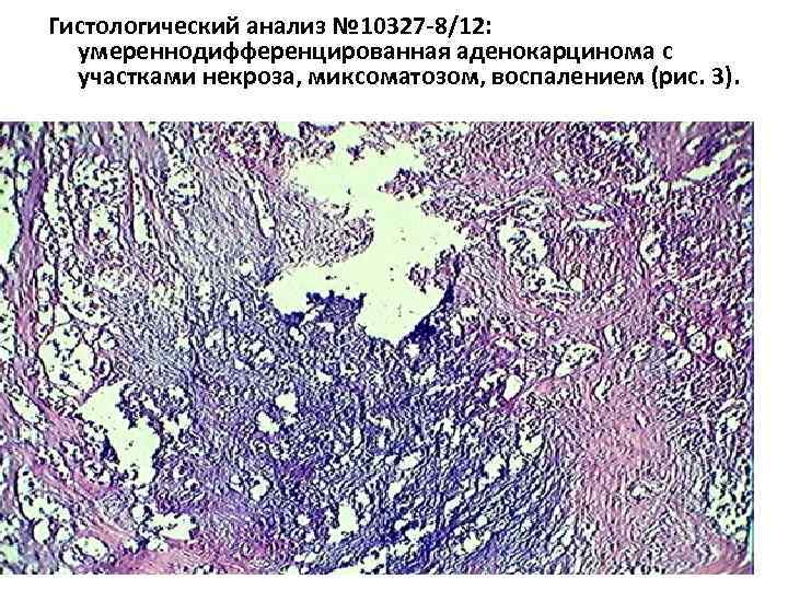 Гистологический анализ № 10327 -8/12: умереннодифференцированная аденокарцинома с участками некроза, миксоматозом, воспалением (рис. 3).