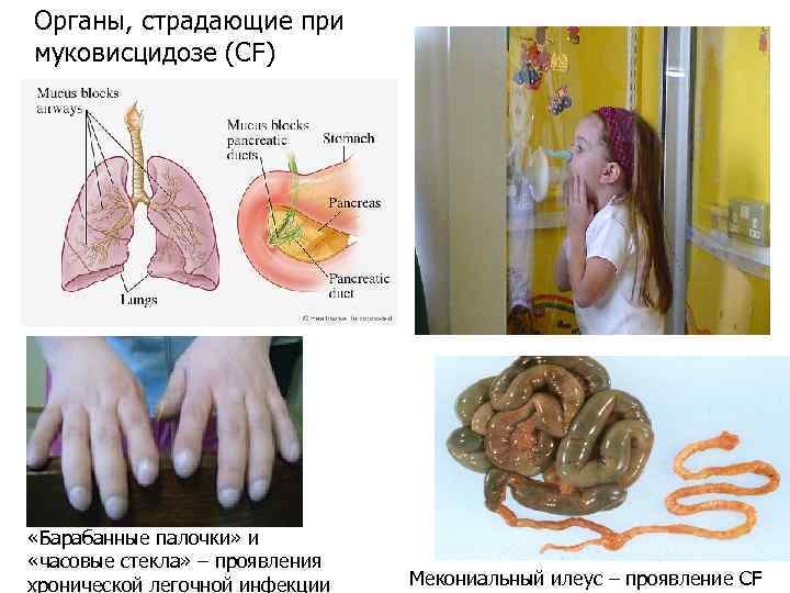 Органы, страдающие при муковисцидозе (СF) «Барабанные палочки» и «часовые стекла» – проявления хронической легочной