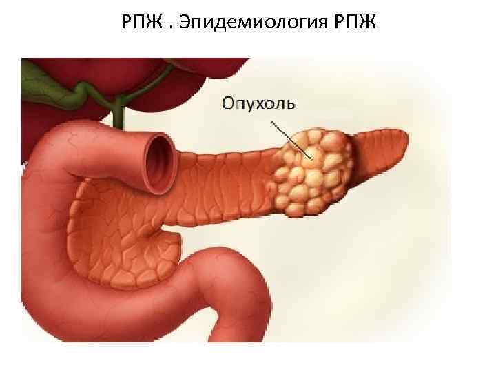 РПЖ. Эпидемиология РПЖ 