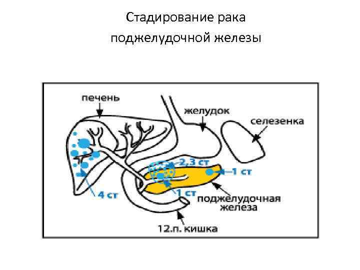 Стадии поджелудочной железы