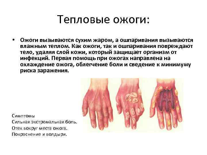 Тепловые ожоги: • Ожоги вызываются сухим жаром, а ошпаривания вызываются влажным теплом. Как ожоги,