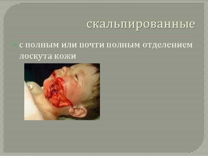 скальпированные с полным или почти полным отделением лоскута кожи 