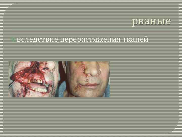 рваные вследствие перерастяжения тканей 