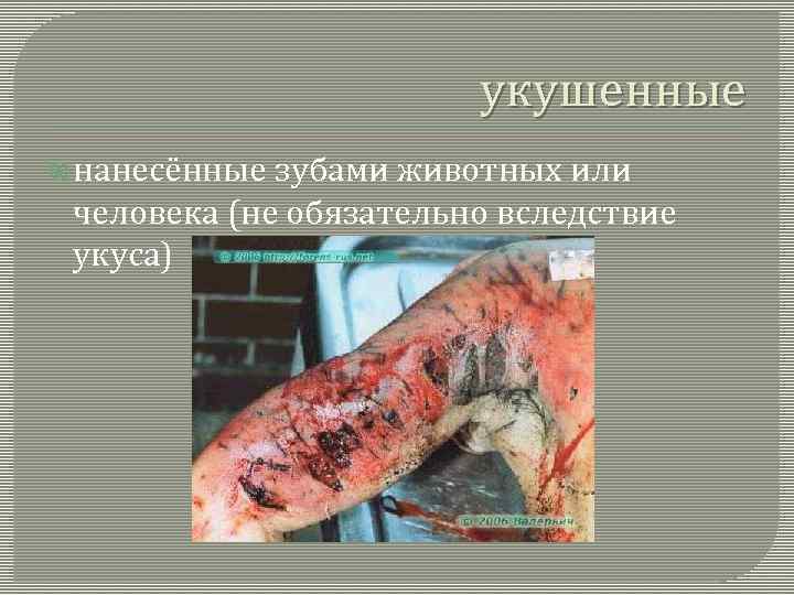 укушенные нанесённые зубами животных или человека (не обязательно вследствие укуса) 