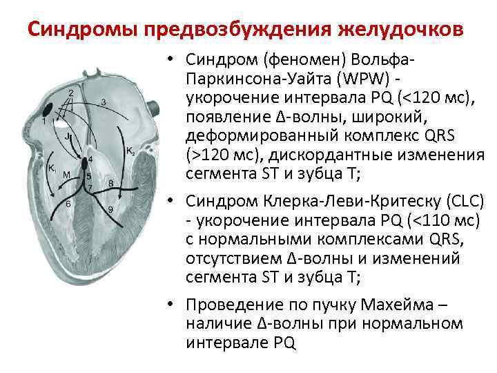 Синдромы предвозбуждения желудочков • Синдром (феномен) Вольфа. Паркинсона-Уайта (WPW) укорочение интервала PQ (<120 мс),