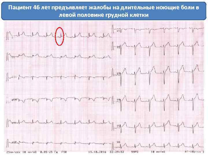 Пациент 46 лет предъявляет жалобы на длительные ноющие боли в левой половине грудной клетки