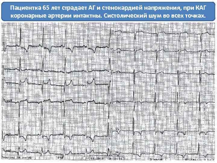 Пациентка 65 лет страдает АГ и стенокардией напряжения, при КАГ коронарные артерии интактны. Систолический