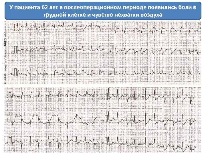 У пациента 62 лет в послеоперационном периоде появились боли в грудной клетке и чувство