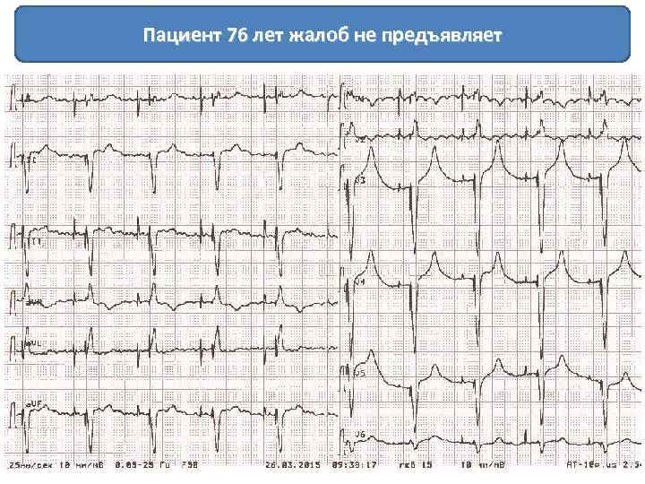Пациент 76 лет жалоб не предъявляет 