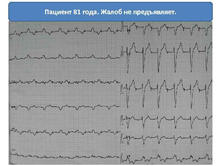 Пациент 81 года. Жалоб не предъявляет. 