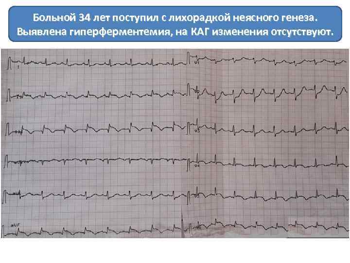 Больной 34 лет поступил с лихорадкой неясного генеза. Выявлена гиперферментемия, на КАГ изменения отсутствуют.