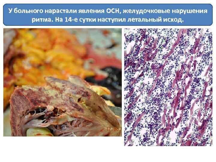 У больного нарастали явления ОСН, желудочковые нарушения ритма. На 14 -е сутки наступил летальный