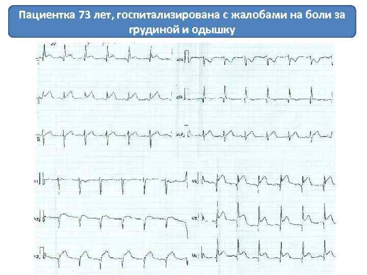 Пациентка 73 лет, госпитализирована с жалобами на боли за грудиной и одышку 