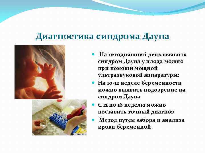 Диагностика синдрома Дауна На сегодняшний день выявить синдром Дауна у плода можно при помощи
