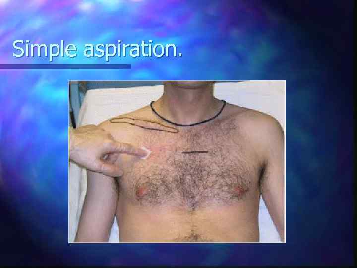 Simple aspiration. 