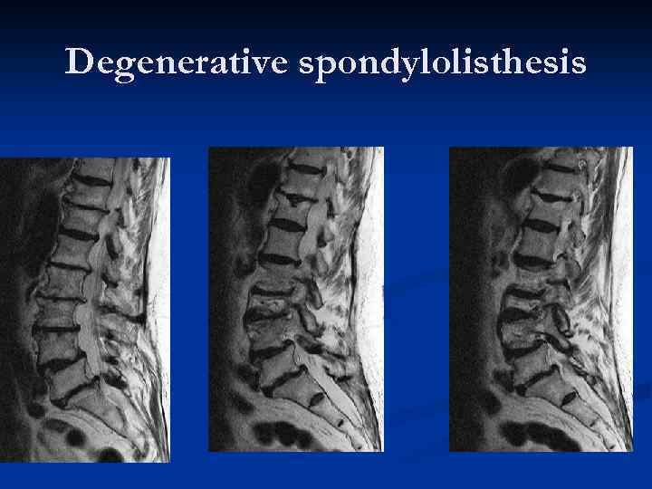 Degenerative spondylolisthesis 