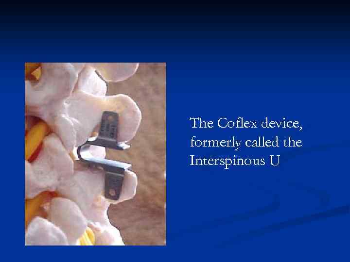 The Coflex device, formerly called the Interspinous U 