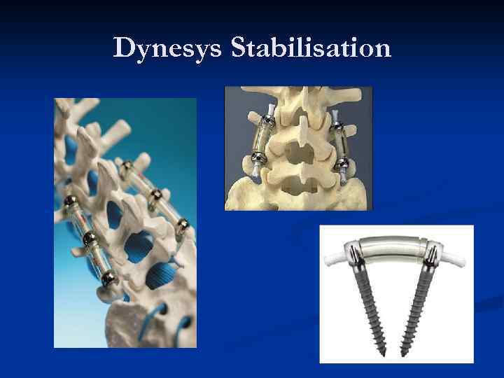 Dynesys Stabilisation 