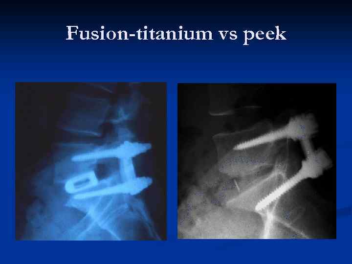 Fusion-titanium vs peek 