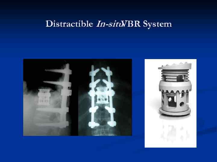 Distractible In-situ VBR System 