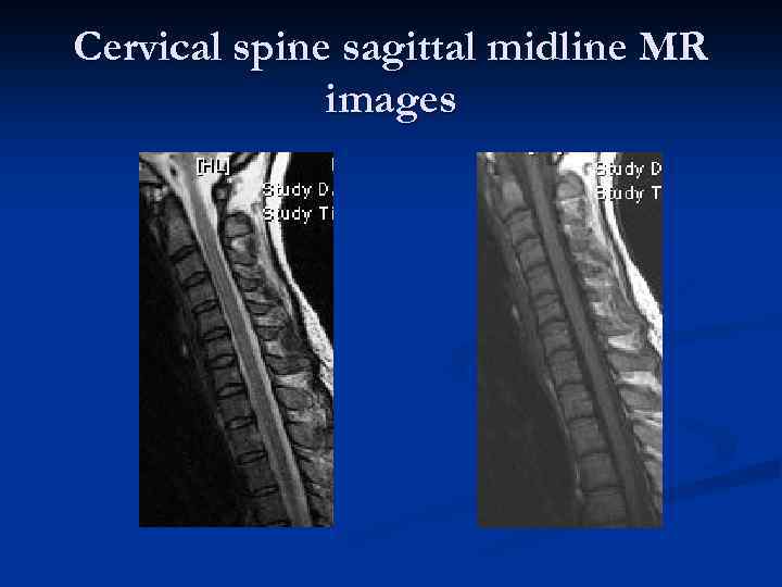 Cervical spine sagittal midline MR images 