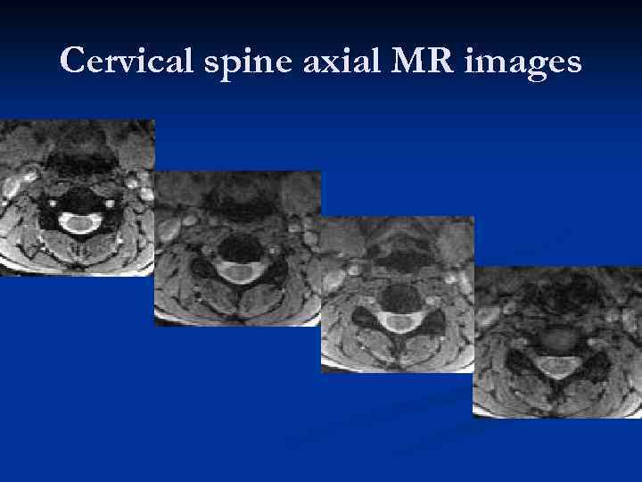 Cervical spine axial MR images 