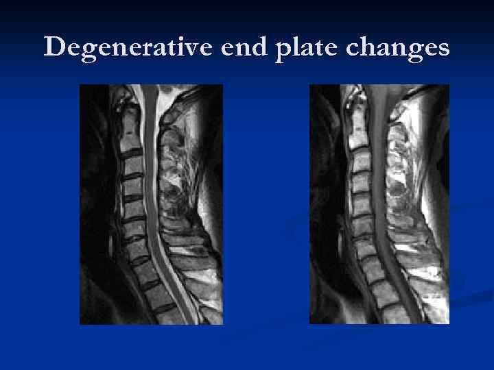 Degenerative end plate changes 