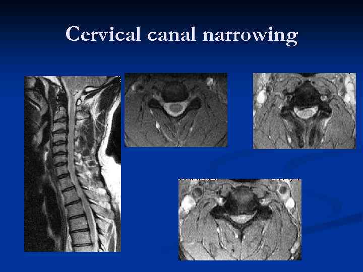 Cervical canal narrowing 