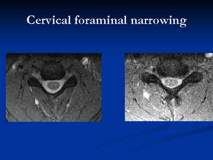 Cervical foraminal narrowing 