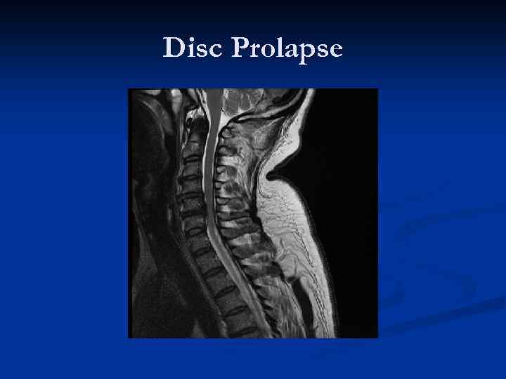 Disc Prolapse 