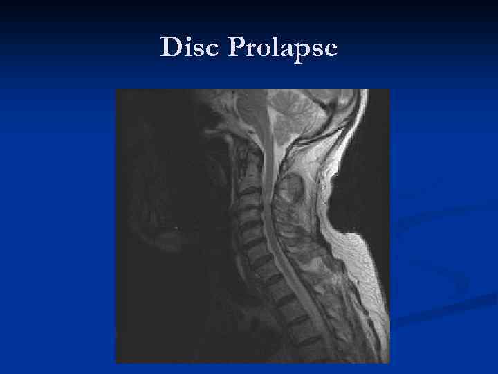 Disc Prolapse 