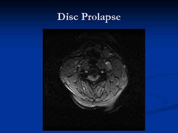 Disc Prolapse 