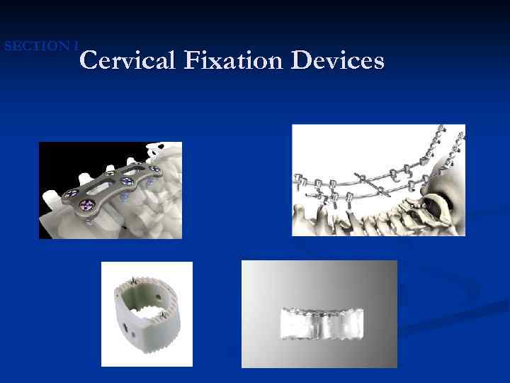 SECTION I Cervical Fixation Devices 