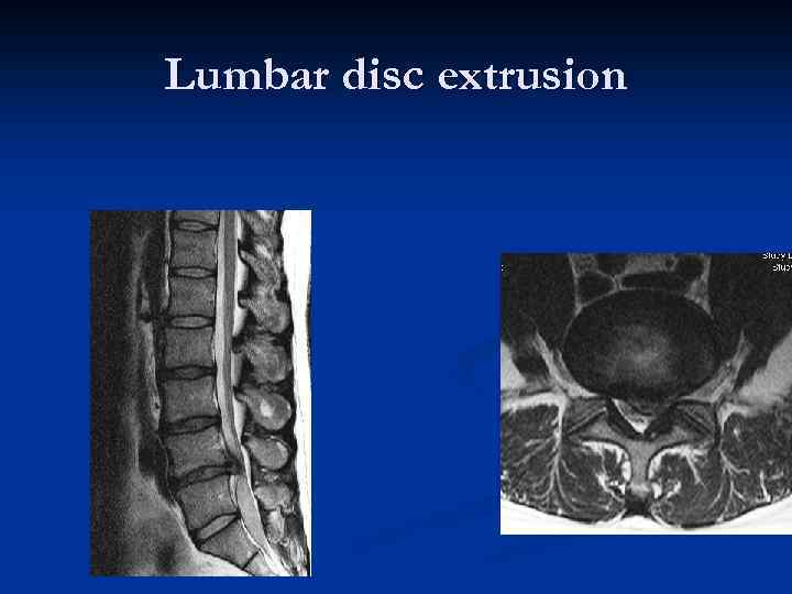 Lumbar disc extrusion 