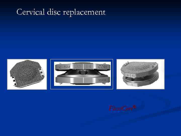 Cervical disc replacement Flexi. Core® 