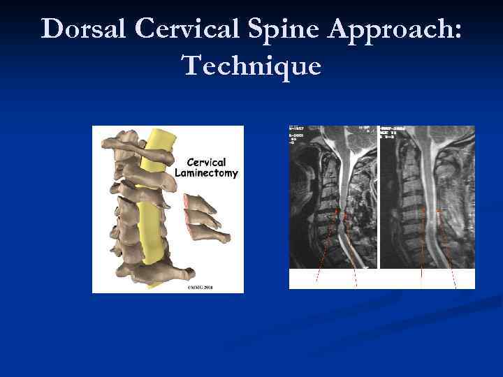 Dorsal Cervical Spine Approach: Technique 