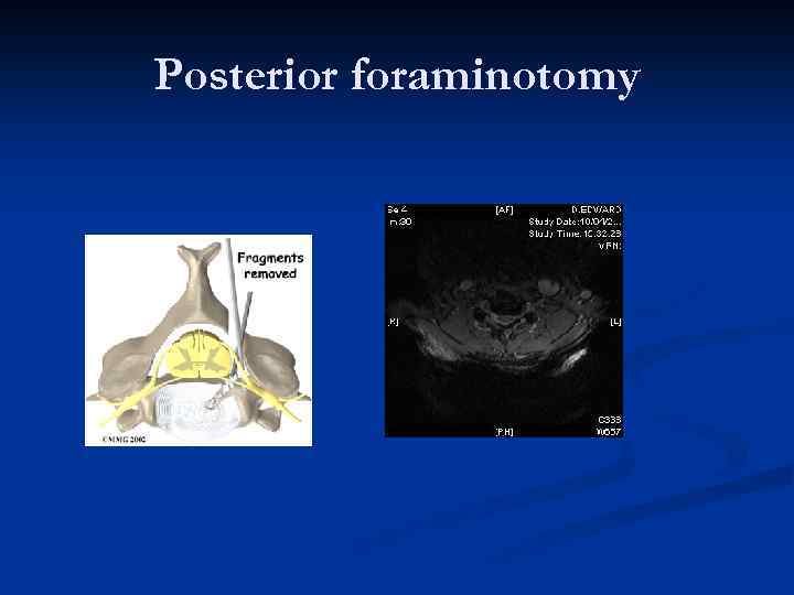 Posterior foraminotomy 