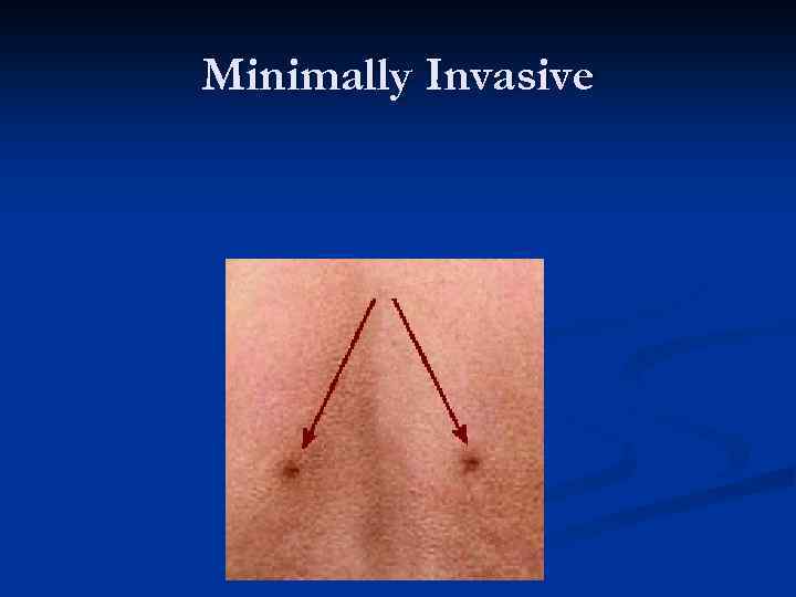 Minimally Invasive 