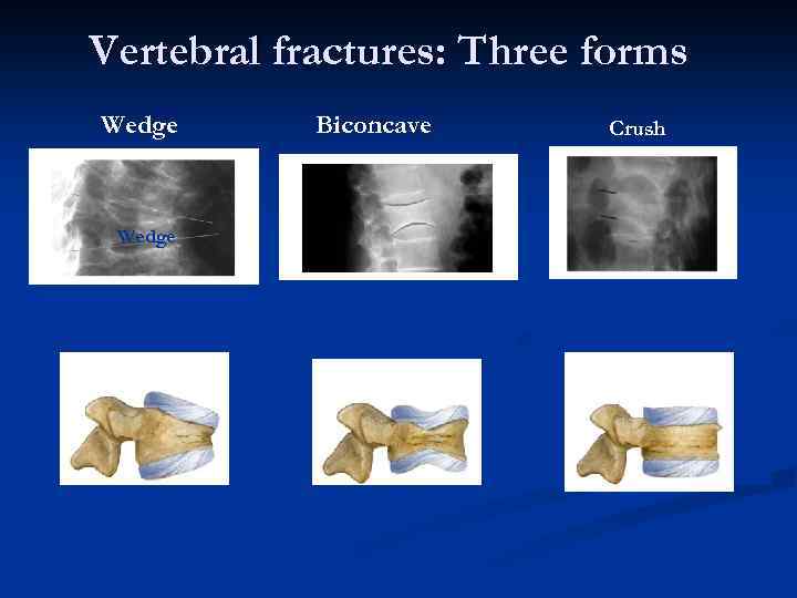 Vertebral fractures: Three forms Wedge Biconcave Crush 