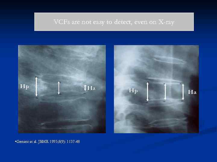 VCFs are not easy to detect, even on X-ray Hp • Genant at al.