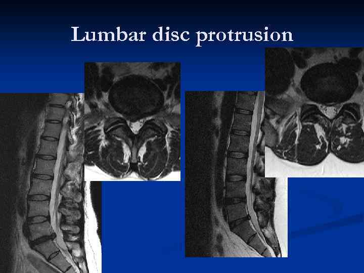 Lumbar disc protrusion 