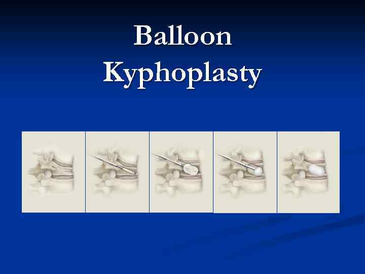 Balloon Kyphoplasty 