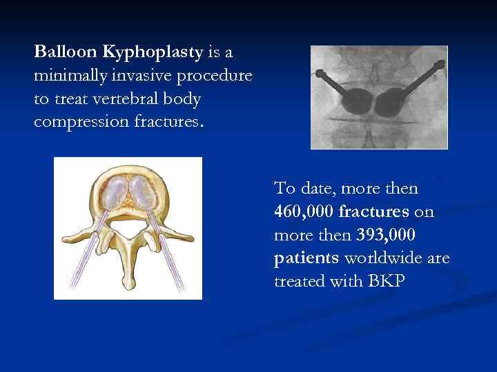 Balloon Kyphoplasty is a minimally invasive procedure to treat vertebral body compression fractures. To