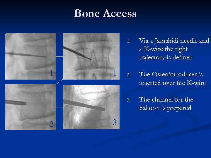 Bone Access 1. 2 1 3 2. The Osteointroducer is inserted over the K-wire