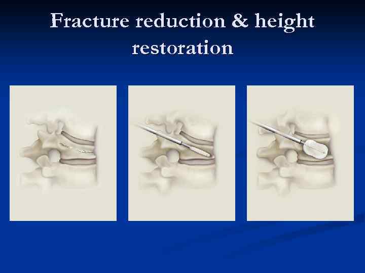 Fracture reduction & height restoration 