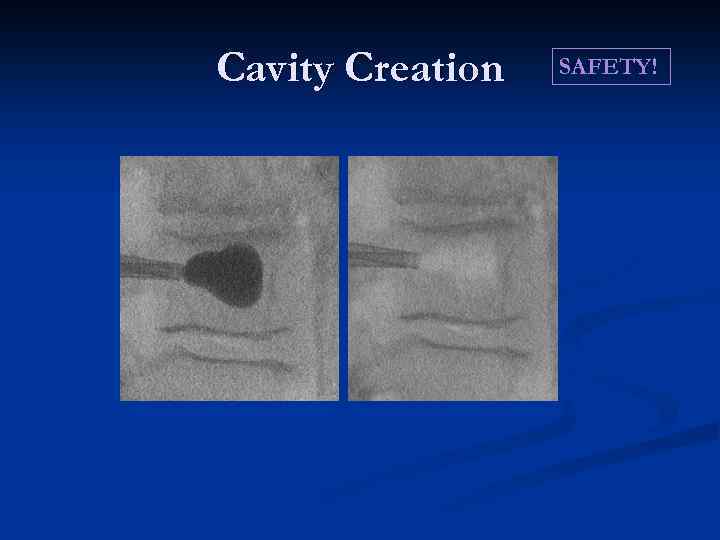 Cavity Creation SAFETY! 