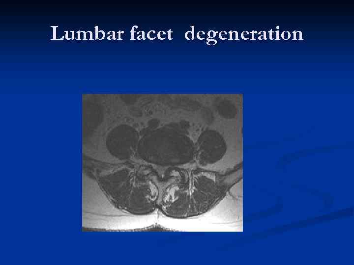 Lumbar facet degeneration 