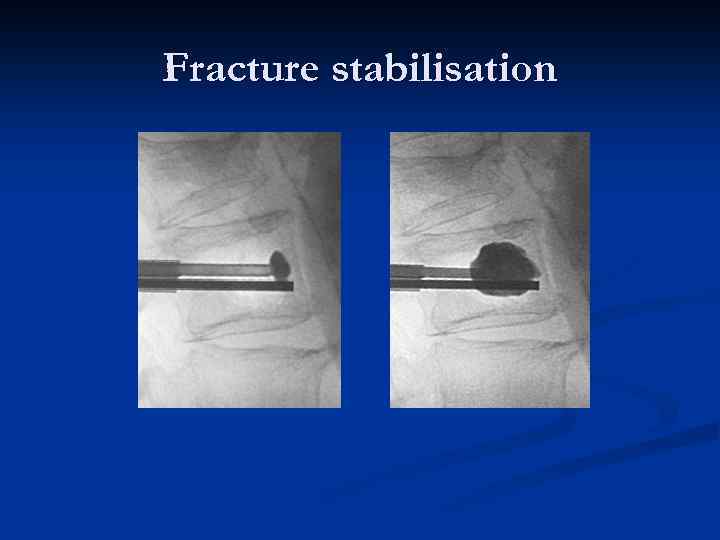 Fracture stabilisation 