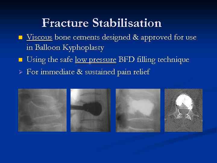 Fracture Stabilisation n n Ø Viscous bone cements designed & approved for use in