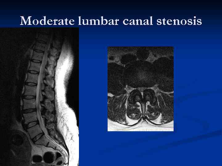 Moderate lumbar canal stenosis 